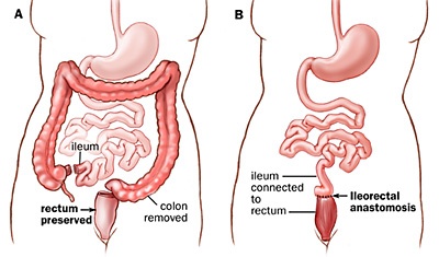 Total Colectomy